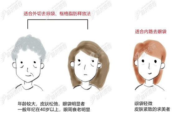 宁波美莱做去眼袋好吗，非手术和超声波祛眼袋实例来科普