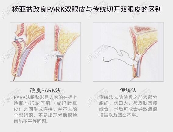 杨亚益医生主做改良法PARK双眼皮