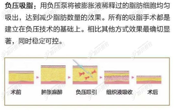 哈尔滨瑞丽做吸脂手术怎么样