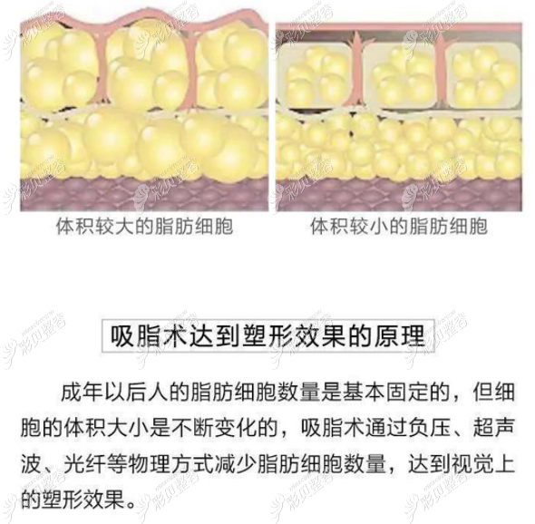 哈尔滨瑞丽抽脂多少钱