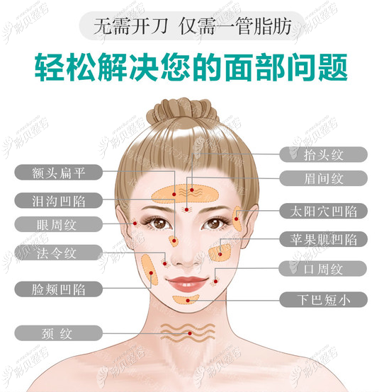 昆明韩辰自体脂肪全脸填充哪个医生做的好,大概需要多少钱