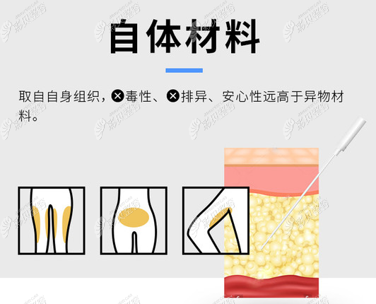 杭州格莱美自体脂肪填充怎么样