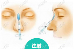 隆鼻整形的手术方法是什么，附耳软骨隆鼻手术过程的图解