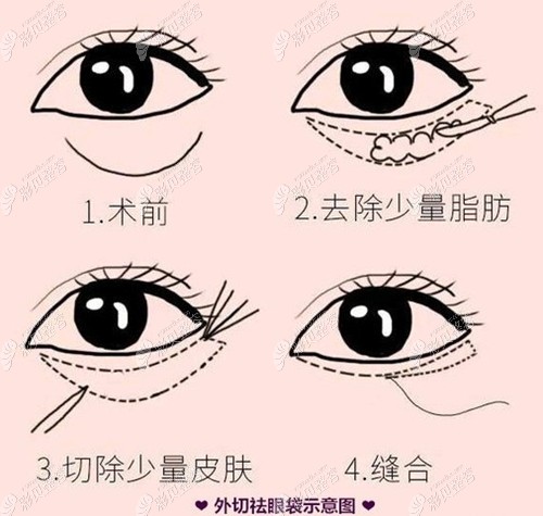 外切去眼袋原理