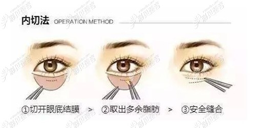 内切去眼袋图示