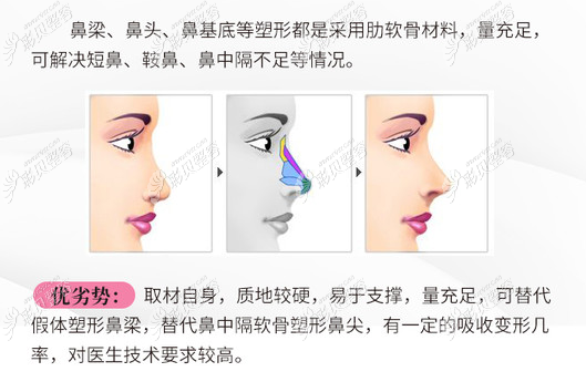 云南铜雀台做自体软骨隆鼻怎么样