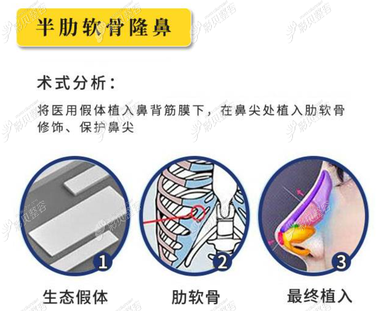 大连爱德丽格做半肋软骨隆鼻怎么样