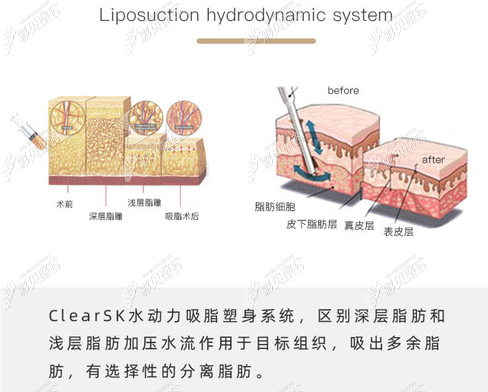 昆明韩辰负压水动力吸脂怎么样
