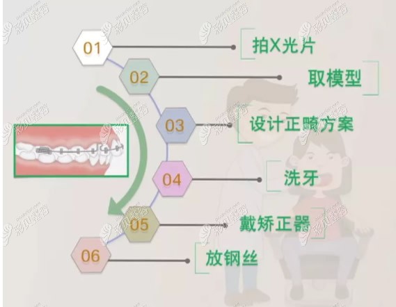 牙齿矫正流程是怎么样的