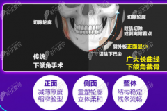 解答广州柳超和徐威强哪个医生做下颌角磨骨手术的风格好