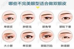 深圳艺星吕瑛医生双眼皮手术做的自然，恢复速度还挺快