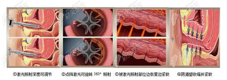 私密激光治疗过程