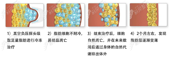 酷塑冷冻溶减脂原理过程 酷塑冷冻溶减脂原理过程