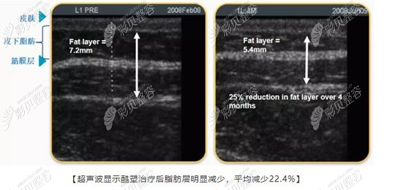 露宿冷冻减脂的效率 露宿冷冻减脂的效率