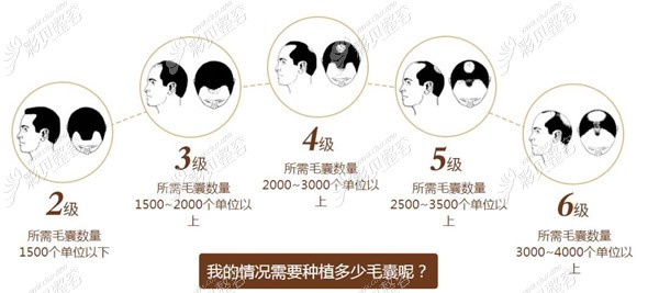 不同脱发等级大概需要种植的毛囊数量