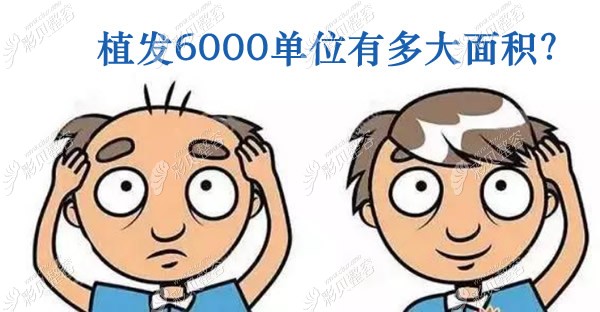 植发6000单位有多大面积