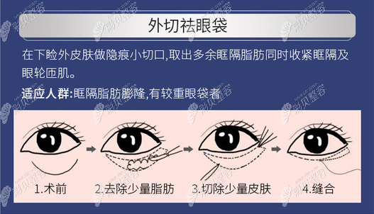 外切去眼袋方法