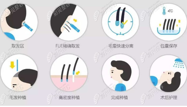 植发手术过程和步骤