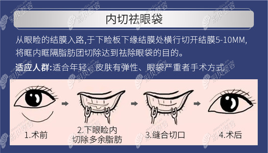 内切去眼袋方法