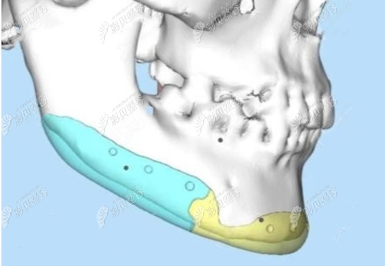 3D人工骨修复下颌角怎么样