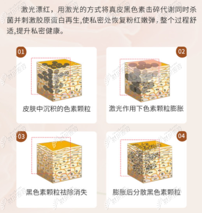 激光镭射私密漂红怎么样