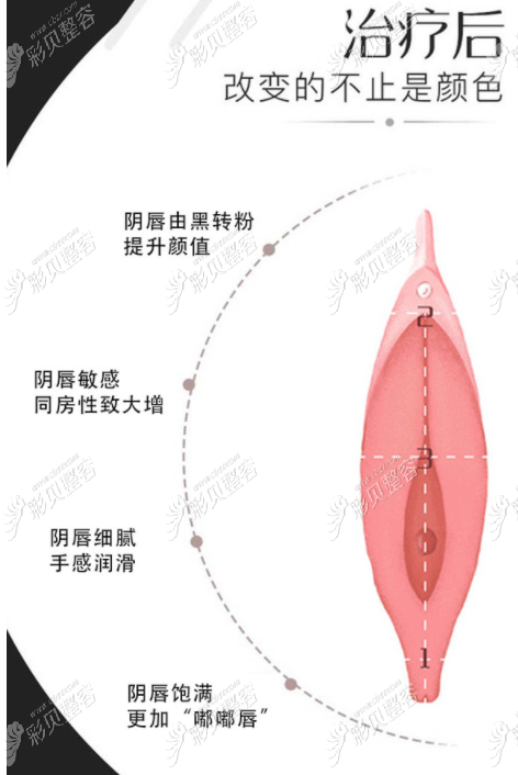 阴唇私密漂红后有什么作用