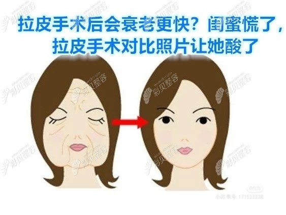 脸部拉皮手术前后对比图片
