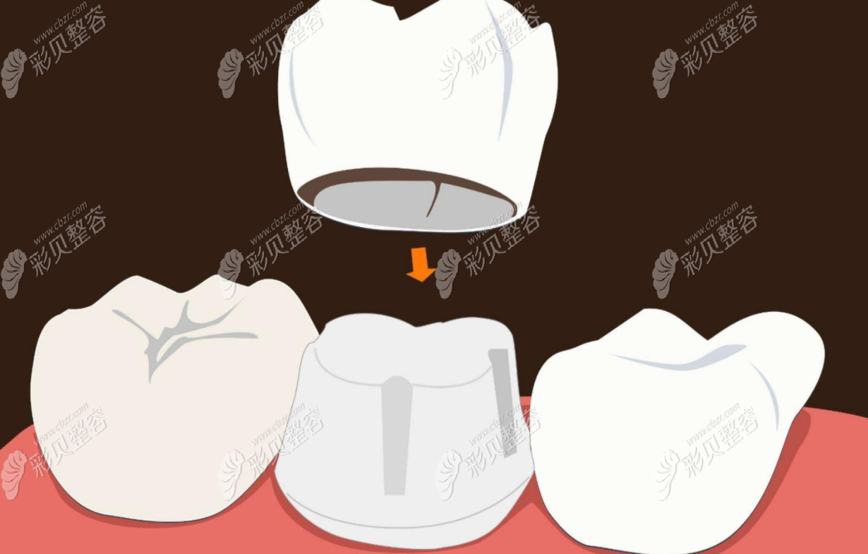 根管治疗后要保护牙齿