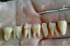 全口种植牙过程分为几个步骤，种牙的过程是不是很遭罪
