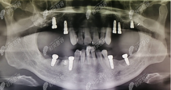 种牙的坏处中牙槽骨可能会坏死