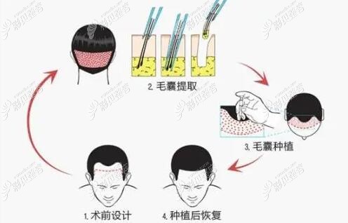传统剃发植发技术流程