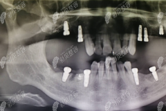 在种牙的好处与危害中发现，种牙后牙龈上有脓包还肿痛