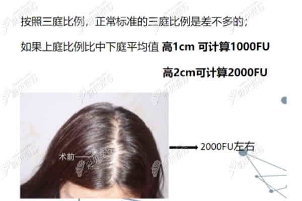 发际线后移1厘米需要种植多少毛囊