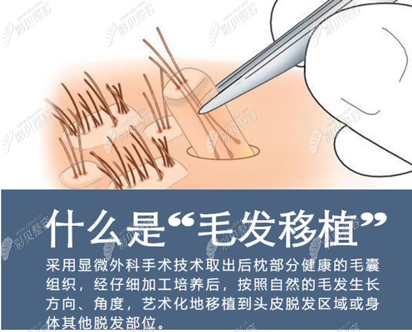 植发的原理和步骤