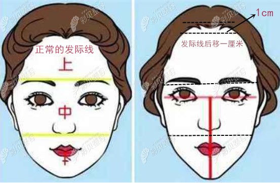 发际线后退了几厘米怎么判断