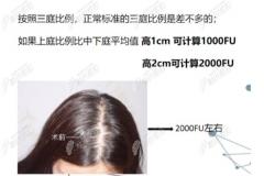 发际线后移一厘米需要植发多少毛囊单位?是1000个还是2000个?