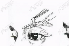 眉下悬吊术与普通提眉术的区别在于三层与单层缝合的不同