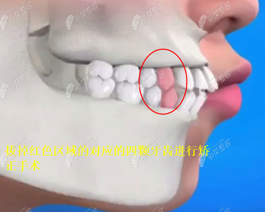 轻微的骨性凸嘴矫正牙齿是有用的