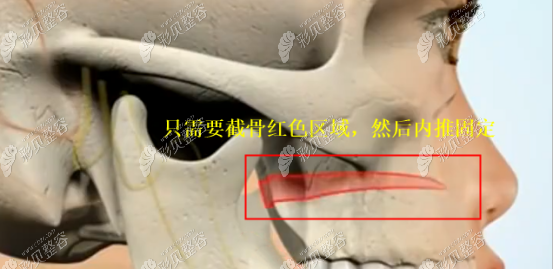 中度骨性凸嘴矫正牙齿是没有用的