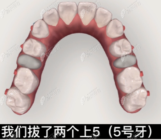 拔掉了我上面的两个5号的牙齿