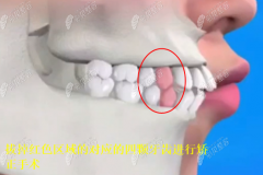 骨性凸嘴矫正牙齿有用吗，真给我拔牙4颗能改善嘴凸么！