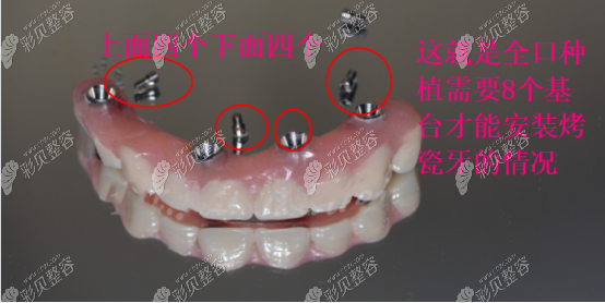 种全口牙齿需要安装8个基台的情况
