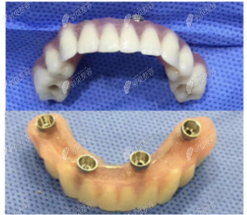 满口种植牙需要几个桩多长时间有做过的人谈谈感受吗