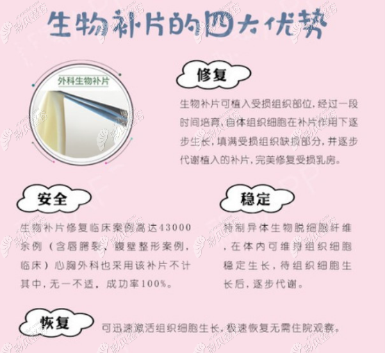 出彩仿真极速丰胸到底咋回事,就是会放置生物补片的一种隆胸技术