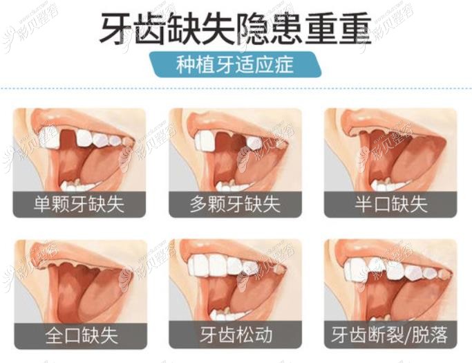 韩国纽白特种植牙适合的牙齿缺失症状 韩国纽白特种植牙适合的牙齿缺失症状