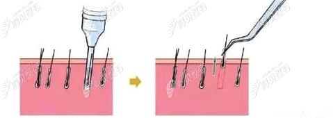 fue无痕植发用镊子取出示意图