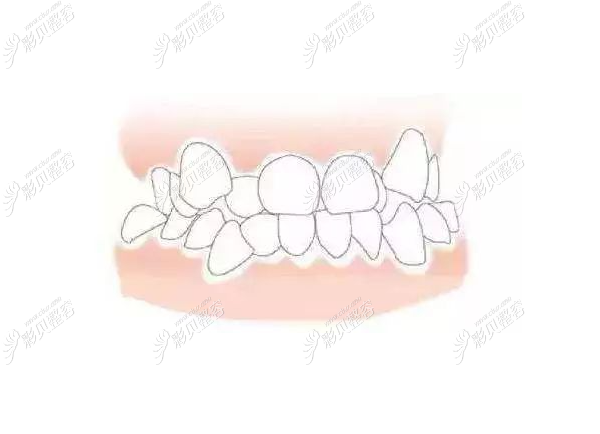 牙齿不整齐可以做隐形矫正或传统矫治