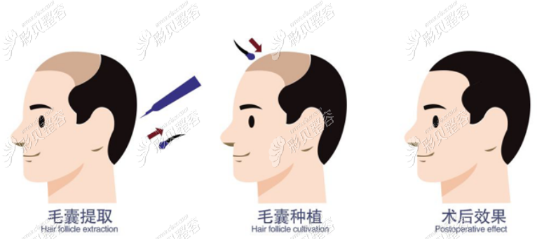 发友们关心的植发的价格和植发面积
