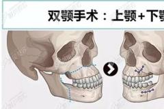 凸嘴手术和双鄂手术的区别图解：具体怎么做我来演示一下