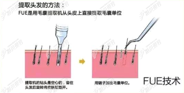传统FUE植发技术提取头发的方法